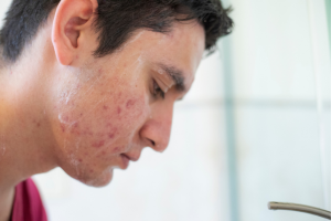 prescription acne treatments