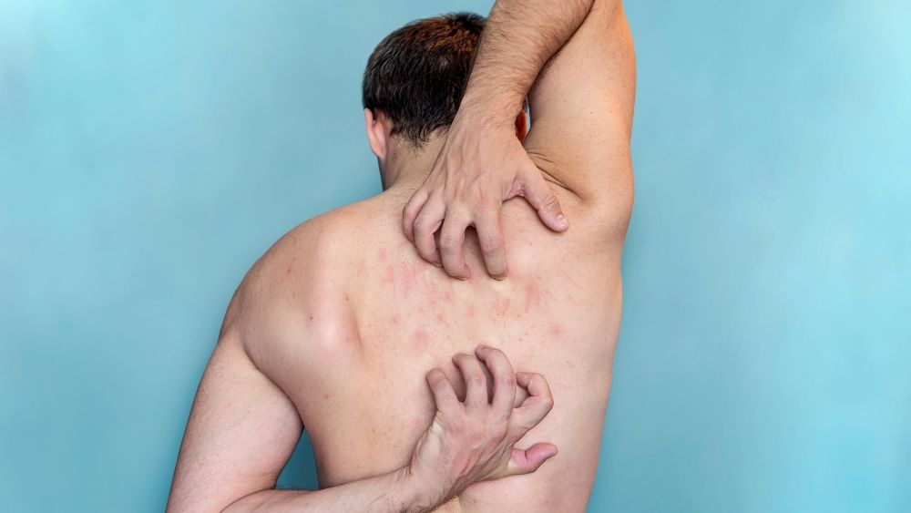 SCABIES TREATMENT