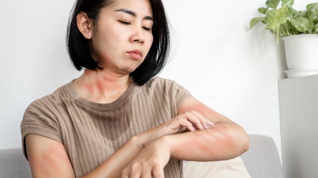 hives treatment online