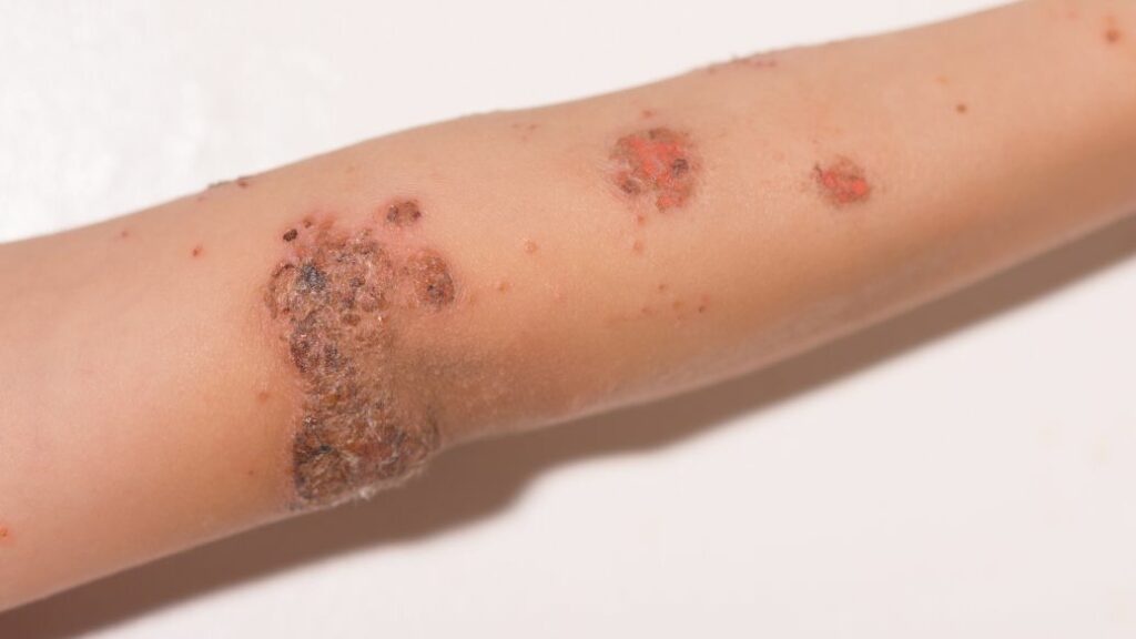 impetigo treatment online