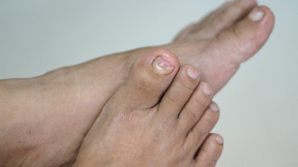 fungal nail infection treatment online