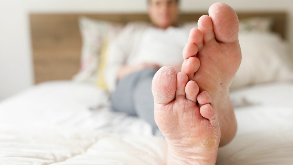 athlete's foot treatment online