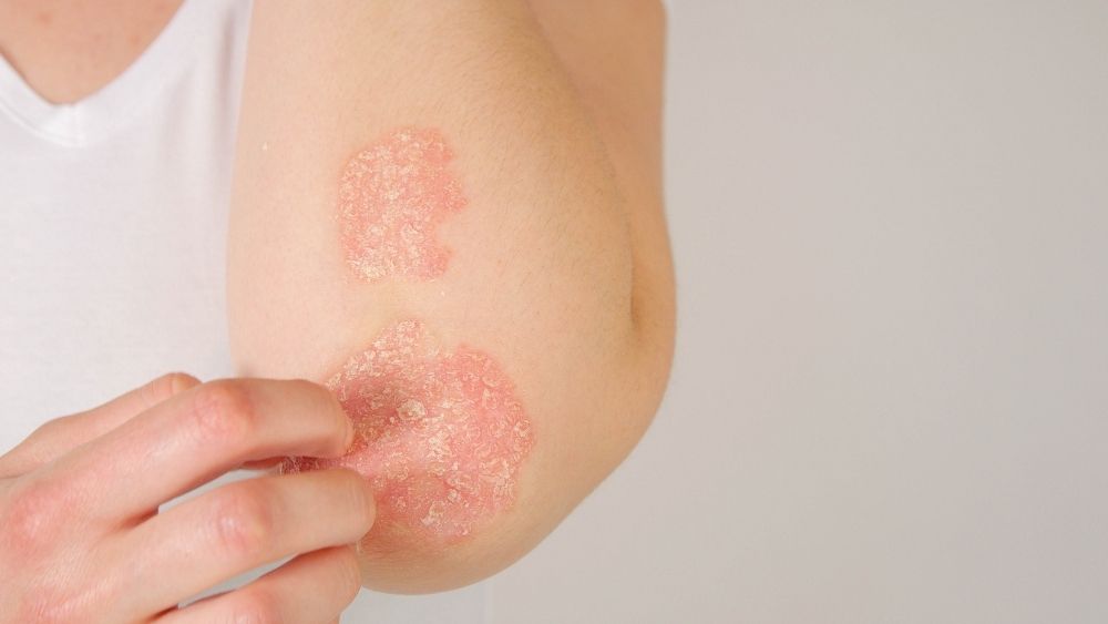 Get Psoriasis Treatment Online